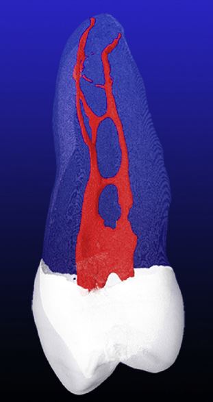 Beispiel CT Bild Wurzelkanalysytem Prämolar